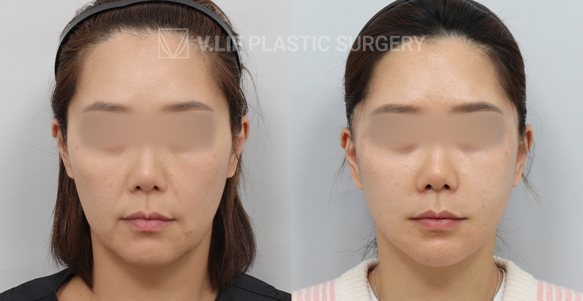 Facelift before and after — Vlif Plastic surgery