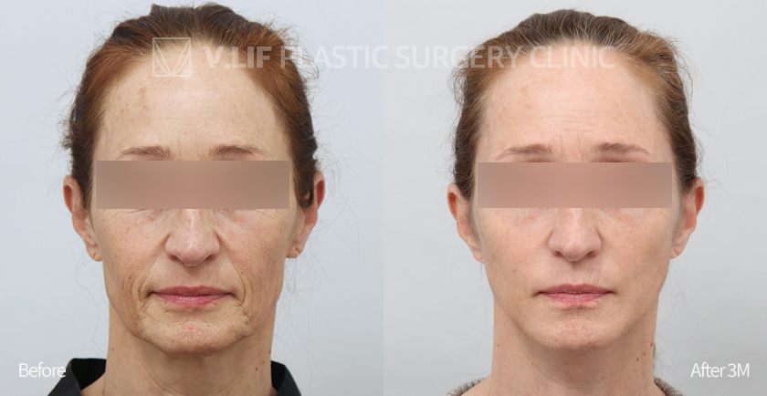 Face Neck Lift Platysma Plication before and after — Vlif Plastic surgery