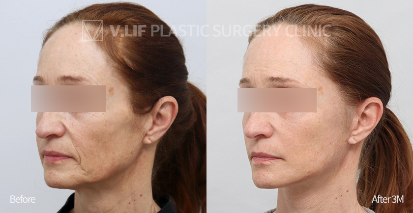 Face Neck Lift Platysma Plication before and after — Vlif Plastic surgery