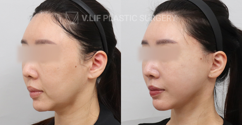 Facelift before and after — Vlif Plastic surgery