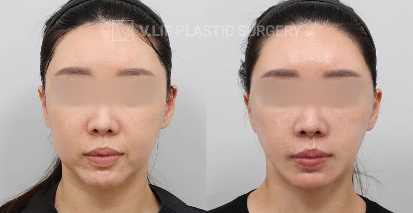Facelift before and after — Vlif Plastic surgery