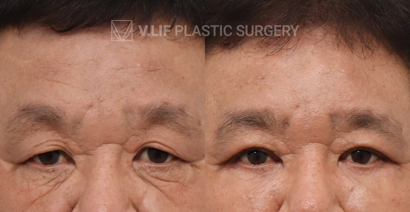 Endoscopic Forehead Lift Upper Blepharoplasty Lower Blepharo before and after — Vlif Plastic surgery