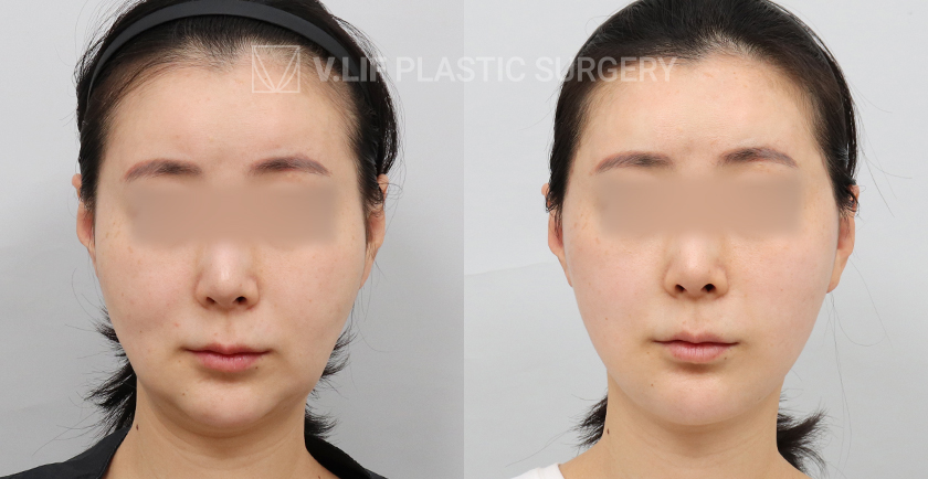 Facelift before and after — Vlif Plastic surgery