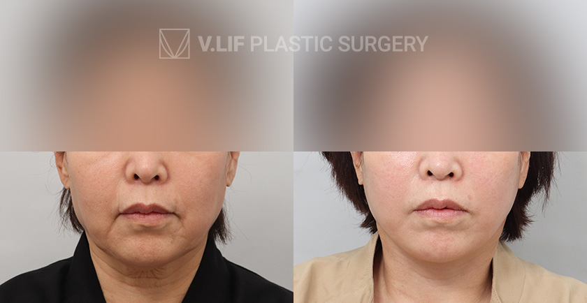 Face Neck Lift Platysma Plication before and after — Vlif Plastic surgery