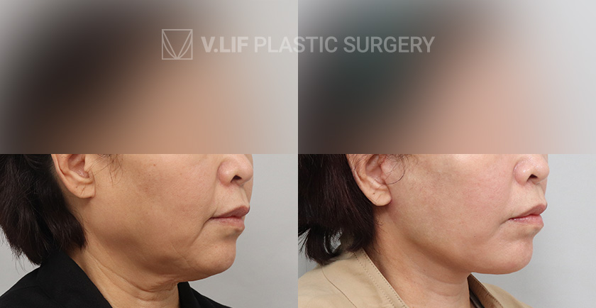 Face Neck Lift Platysma Plication before and after — Vlif Plastic surgery