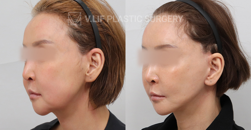 Facelift before and after — Vlif Plastic surgery