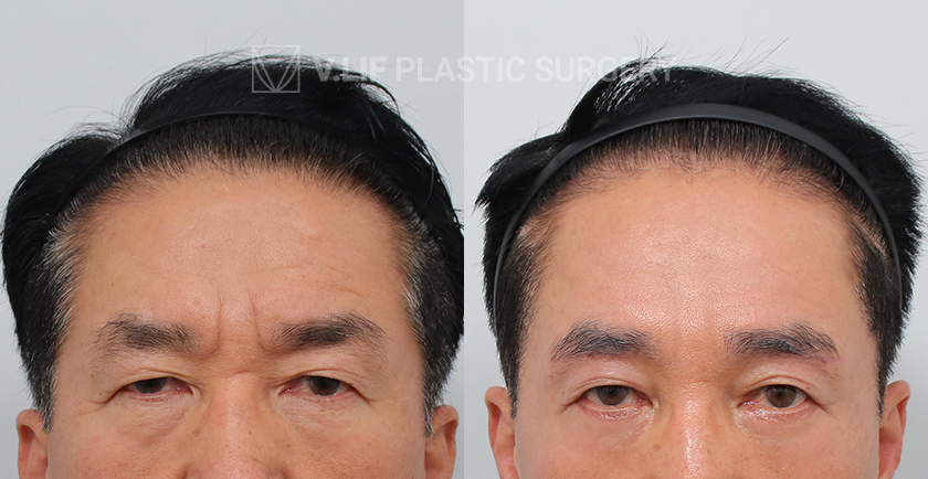 Endoscopic Forehead Lift before and after — Vlif Plastic surgery