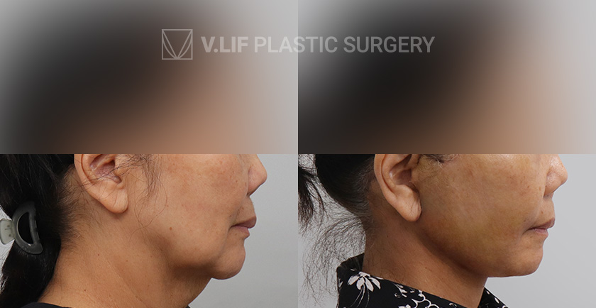Face Neck Lift before and after — Vlif Plastic surgery