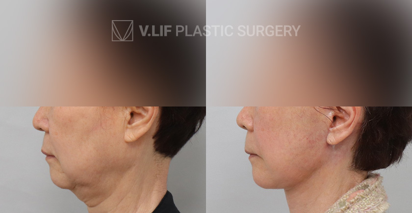 Face Neck Lift Platysma Plication before and after — Vlif Plastic surgery