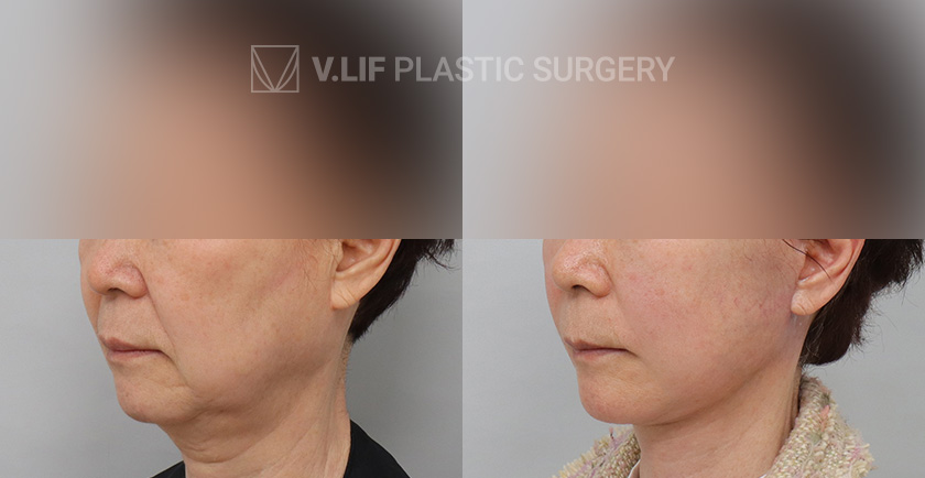 Face Neck Lift Platysma Plication before and after — Vlif Plastic surgery