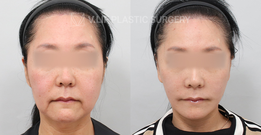 Mini Lift before and after — Vlif Plastic surgery