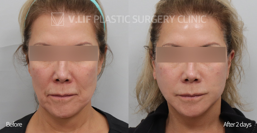 Revision Facelift before and after — Vlif Plastic surgery