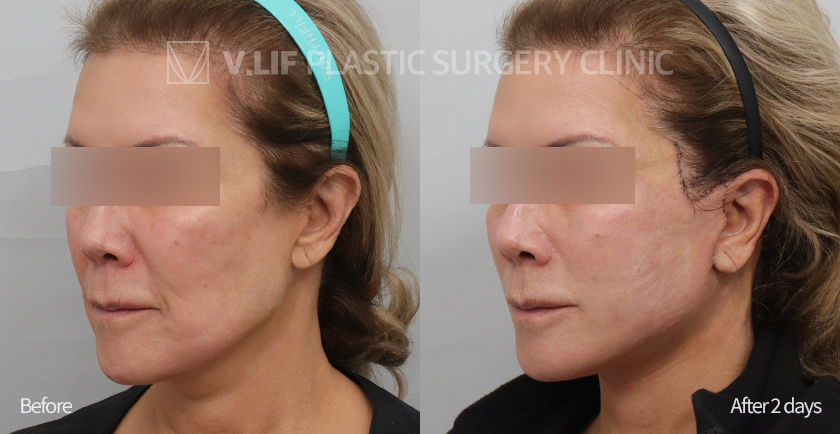 Revision Facelift before and after — Vlif Plastic surgery
