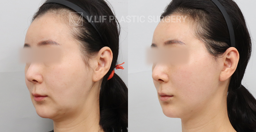 Facelift before and after — Vlif Plastic surgery