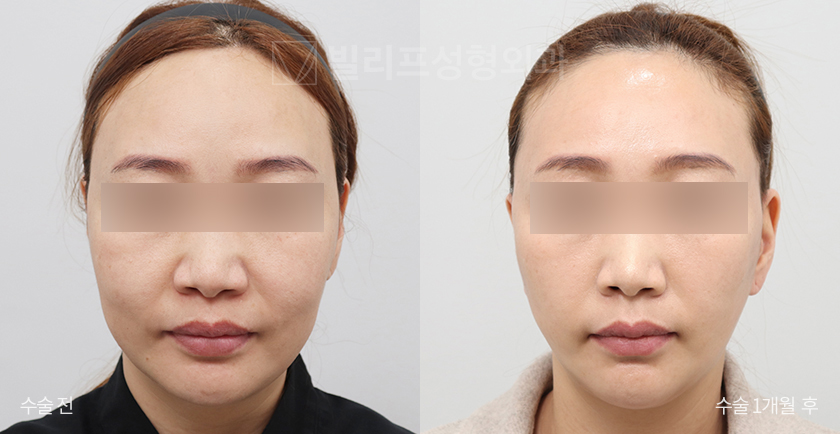 Facelift + Endoscopic Forehead Lift before and after — Vlif Plastic surgery