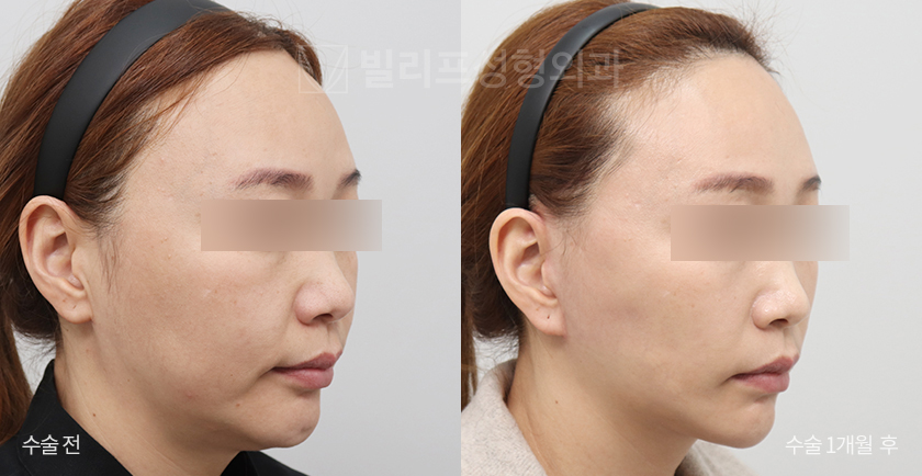 Facelift + Endoscopic Forehead Lift before and after — Vlif Plastic surgery