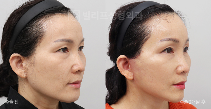 Facelift Endoscopic Forehead Lift before and after — Vlif Plastic surgery