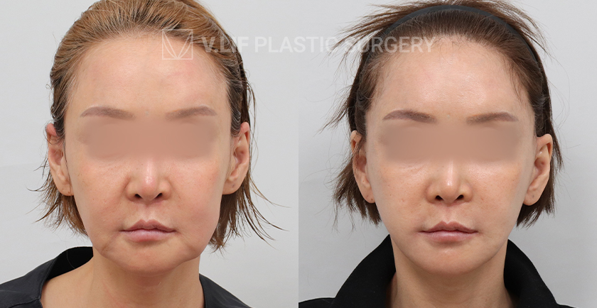 Facelift before and after — Vlif Plastic surgery