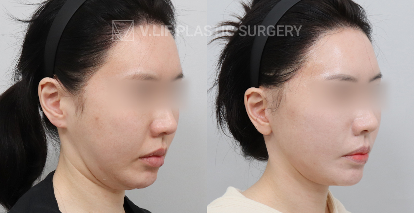Facelift before and after — Vlif Plastic surgery
