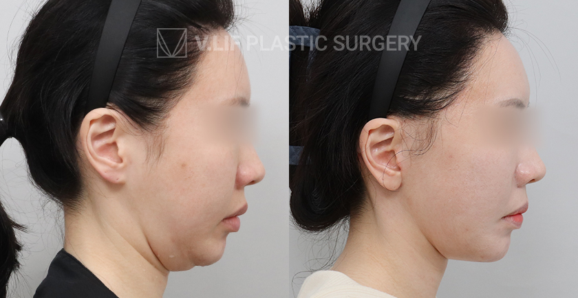 Facelift before and after — Vlif Plastic surgery