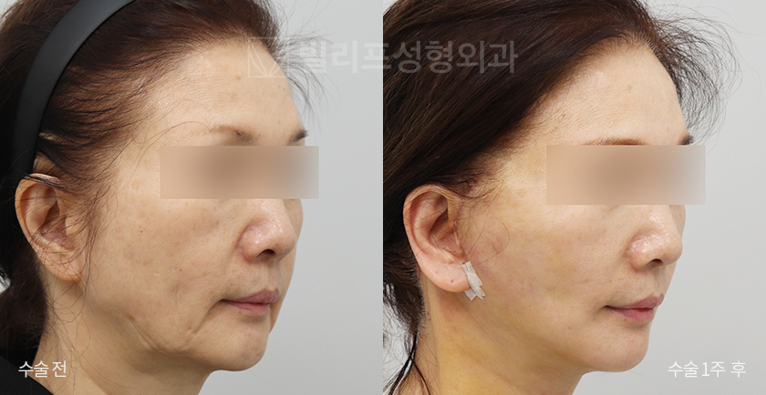 All-in Lift: Facelift + Neck Lift + Neck Wrinkle Injection before and after — Vlif Plastic surgery