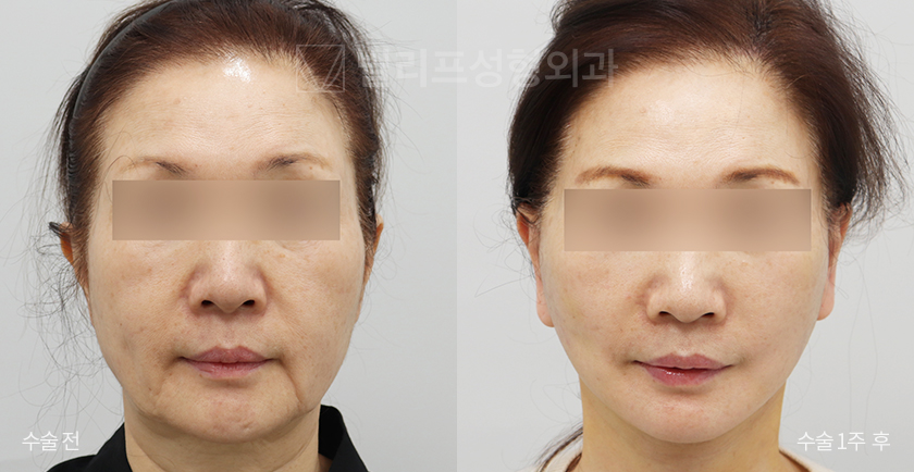 All-in Lift: Facelift + Neck Lift + Neck Wrinkle Injection before and after — Vlif Plastic surgery