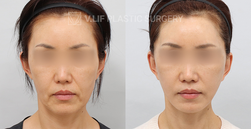 Facelift before and after — Vlif Plastic surgery