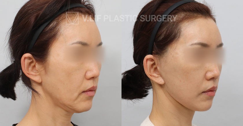 Facelift before and after — Vlif Plastic surgery