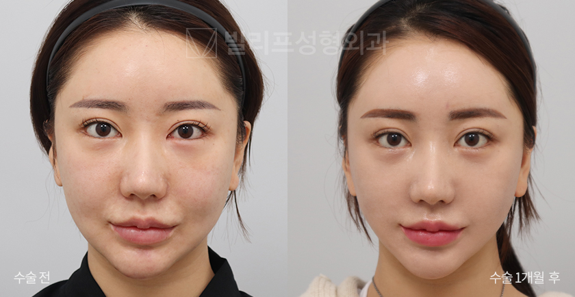 Mini Lift (Lower Face) + Endoscopic Forehead Lift before and after — Vlif Plastic surgery