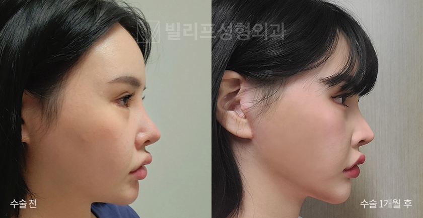 Mini Lift (Selfie) before and after — Vlif Plastic surgery