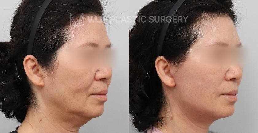 Facelift before and after — Vlif Plastic surgery