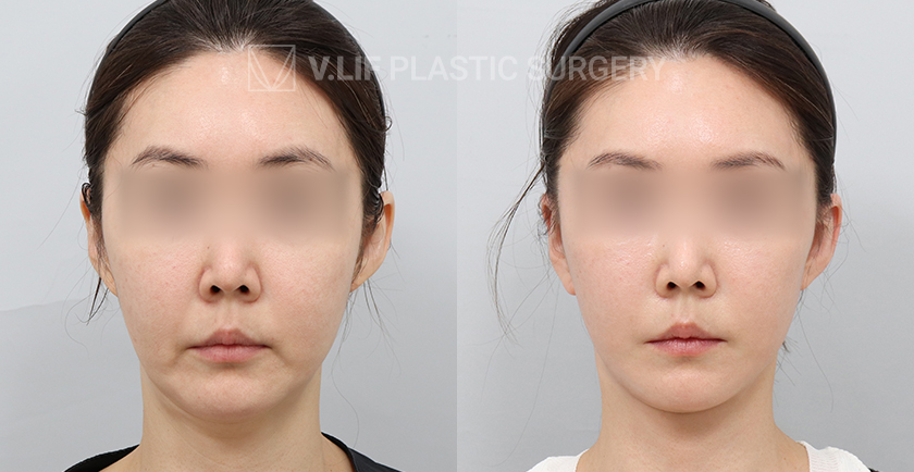 Facelift before and after — Vlif Plastic surgery