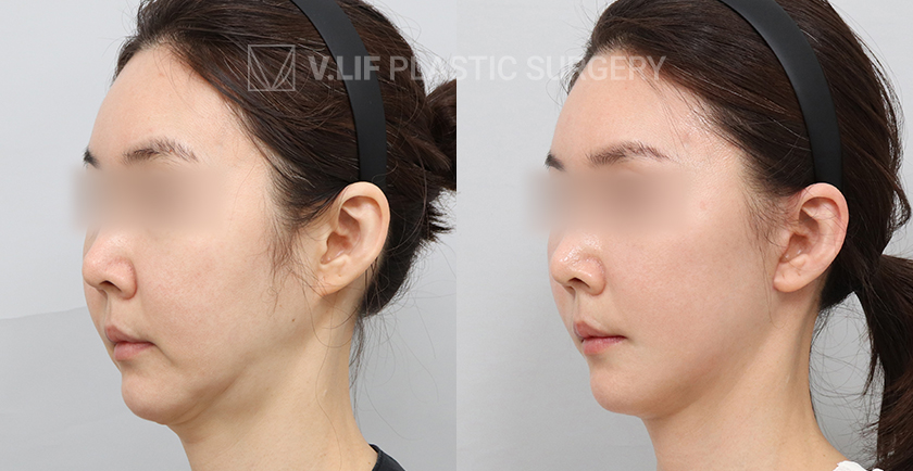 Facelift before and after — Vlif Plastic surgery