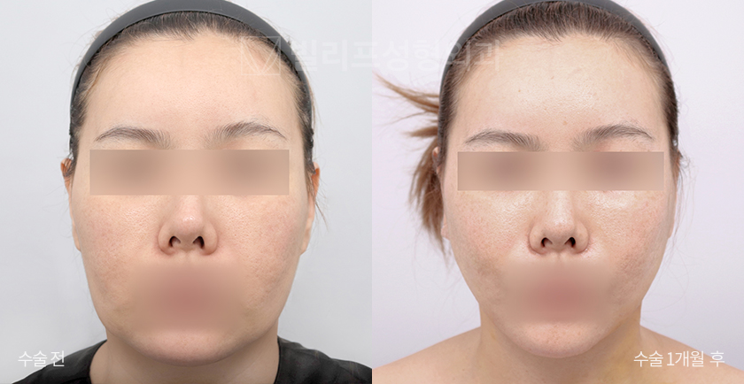 Mini Lift (Lower Face) + Facial Liposuction before and after — Vlif Plastic surgery