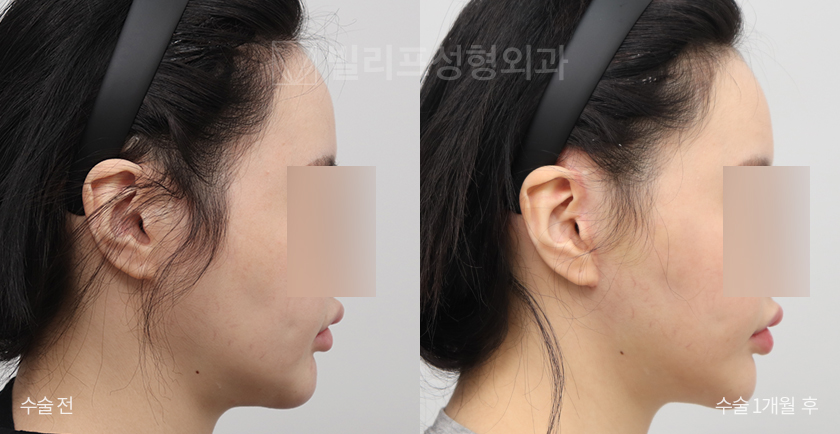 Mini Lift (Lower Face, Double Chin) + Facial Liposuction before and after — Vlif Plastic surgery