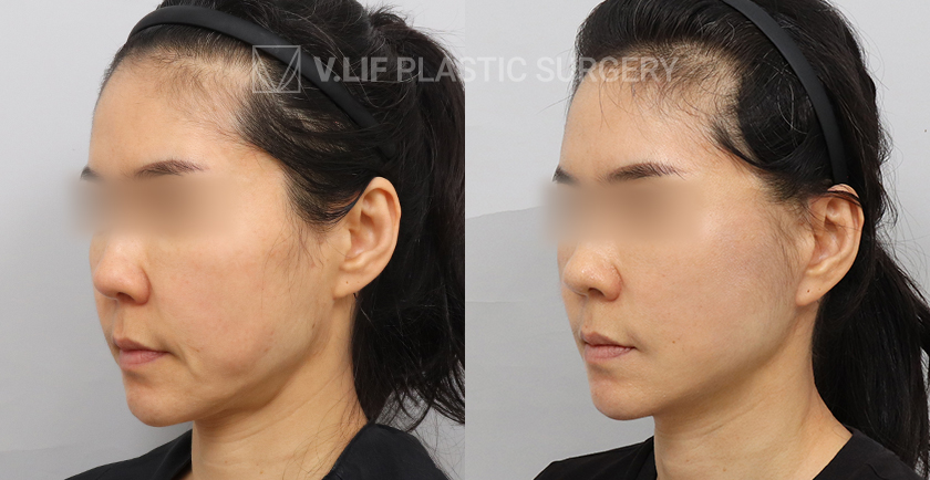 Facelift before and after — Vlif Plastic surgery