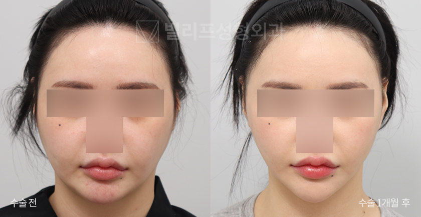 Mini Lift (Lower Face, Double Chin) + Facial Liposuction before and after — Vlif Plastic surgery