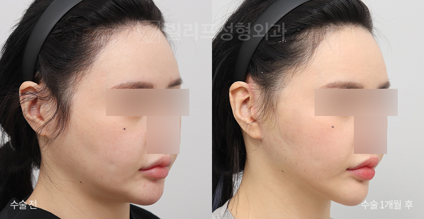 Mini Lift (Lower Face, Double Chin) + Facial Liposuction before and after — Vlif Plastic surgery