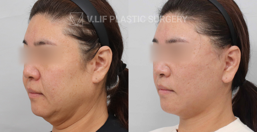 Facelift before and after — Vlif Plastic surgery