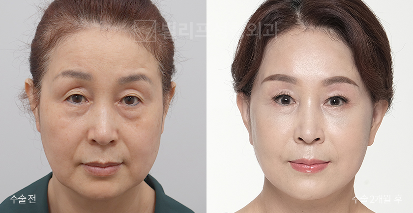 Facelift + Neck Lift + Endoscopic Forehead Lift + Sub-brow Lift + Facial Fat Removal before and after — Vlif Plastic surgery