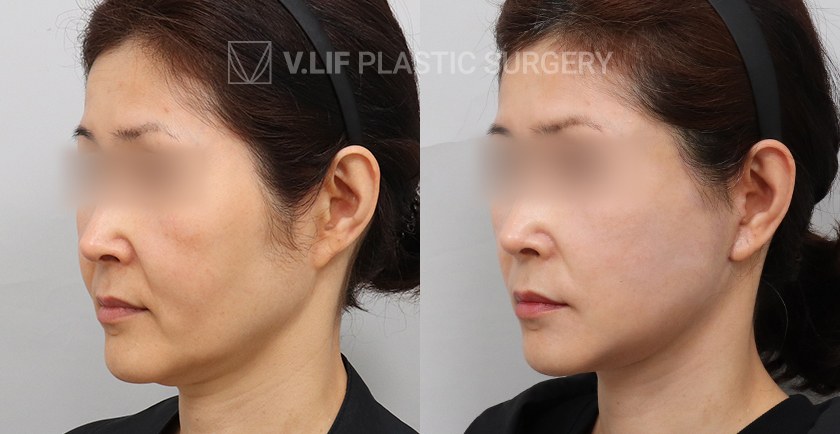 Facelift before and after — Vlif Plastic surgery