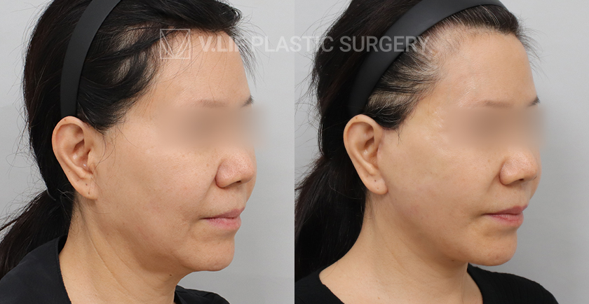 Facelift before and after — Vlif Plastic surgery