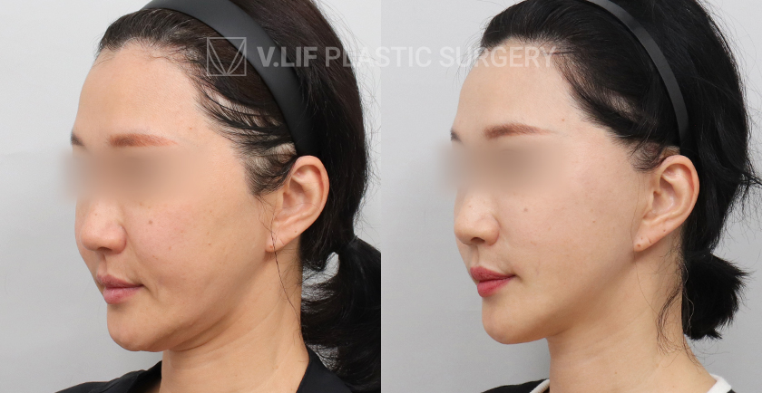 Facelift before and after — Vlif Plastic surgery