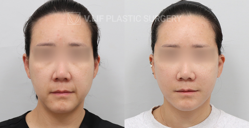 Facelift before and after — Vlif Plastic surgery