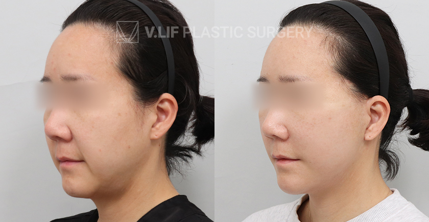 Facelift before and after — Vlif Plastic surgery