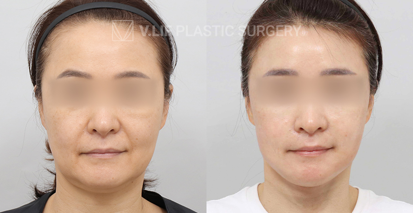 Facelift before and after — Vlif Plastic surgery