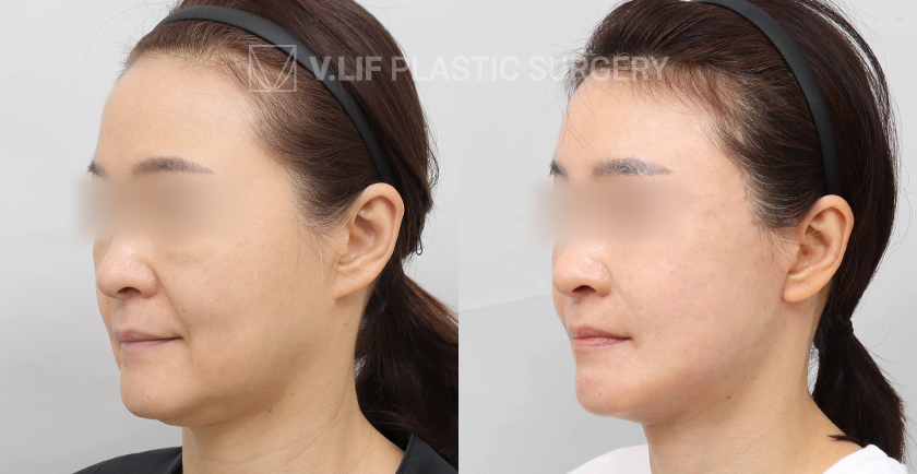 Facelift before and after — Vlif Plastic surgery