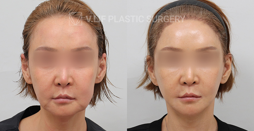 Facelift before and after — Vlif Plastic surgery