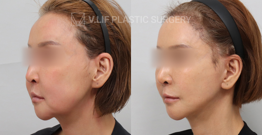 Facelift before and after — Vlif Plastic surgery