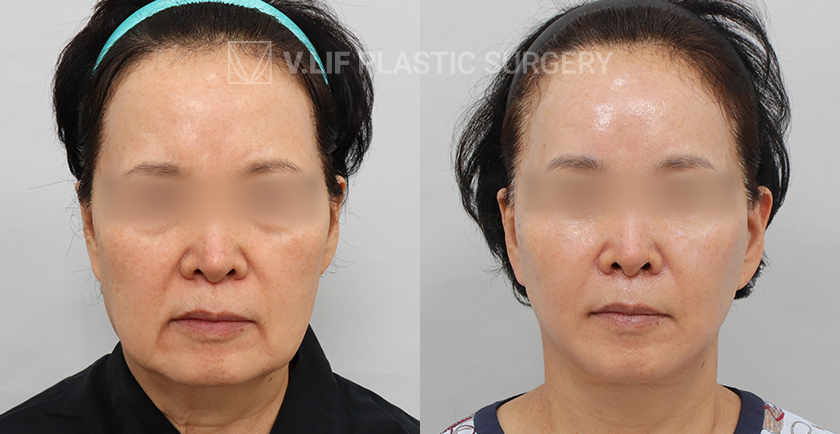 Facelift before and after — Vlif Plastic surgery